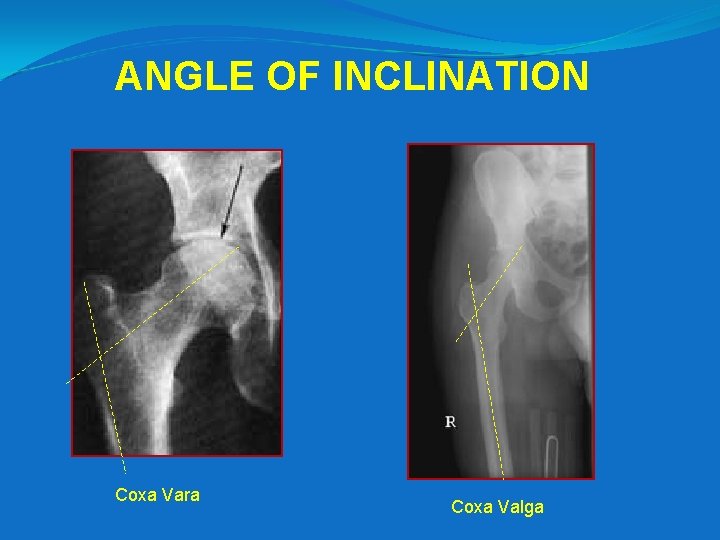 ANGLE OF INCLINATION Coxa Vara Coxa Valga 