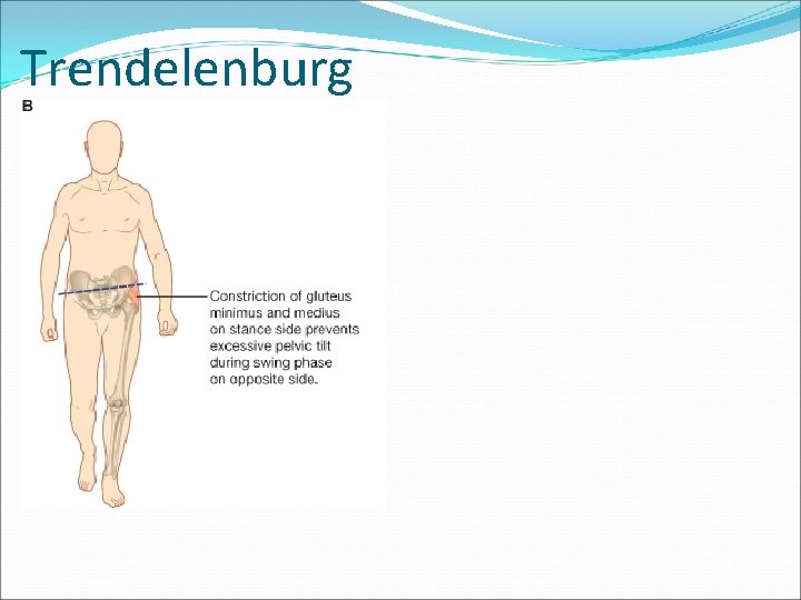 Trendelenburg 
