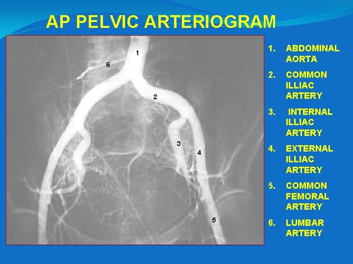 AP PELVIC ARTERIOGRAM 1 1. ABDOMINAL AORTA 2. COMMON ILLIAC ARTERY 3. INTERNAL ILLIAC