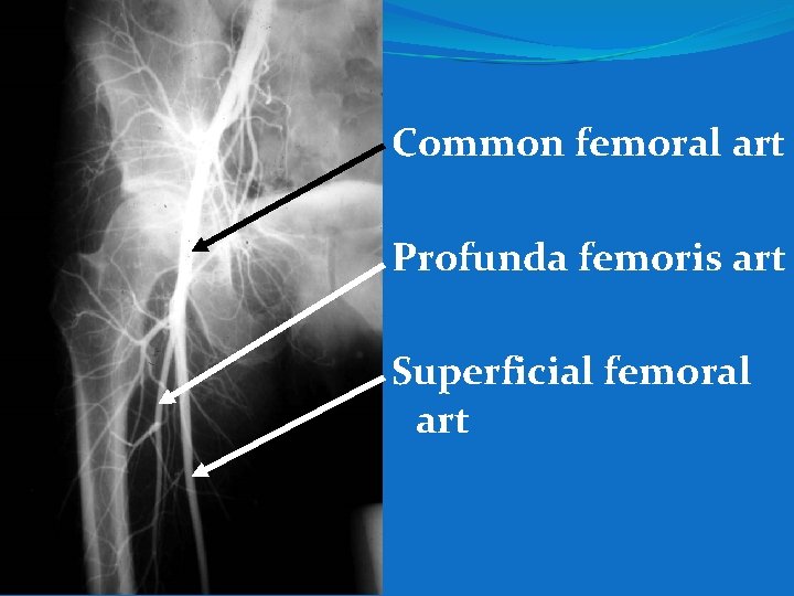Common femoral art Profunda femoris art Superficial femoral art 