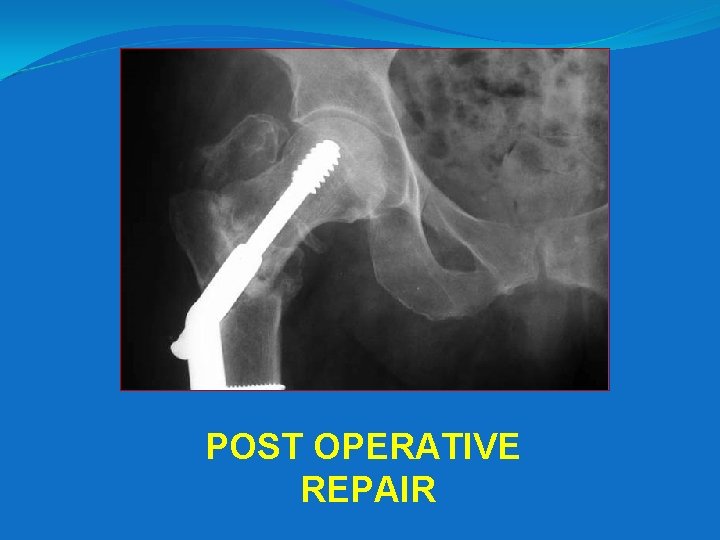POST OPERATIVE REPAIR 
