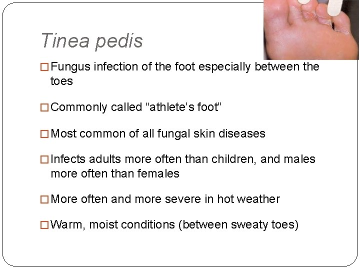 Tinea pedis � Fungus infection of the foot especially between the toes � Commonly