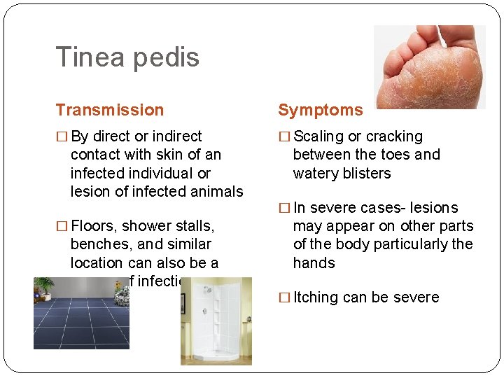 Tinea pedis Transmission Symptoms � By direct or indirect � Scaling or cracking contact