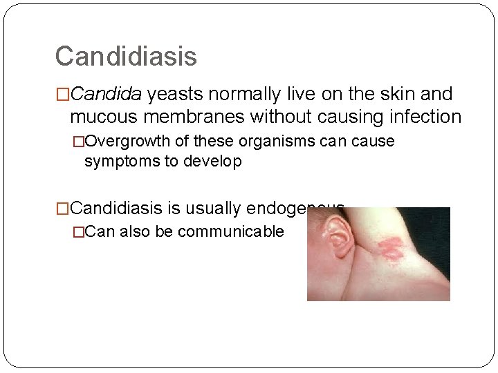 Candidiasis �Candida yeasts normally live on the skin and mucous membranes without causing infection