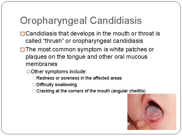 Oropharyngeal Candidiasis � Candidiasis that develops in the mouth or throat is called “thrush”