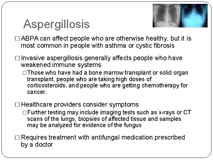 Aspergillosis � ABPA can affect people who are otherwise healthy, but it is most