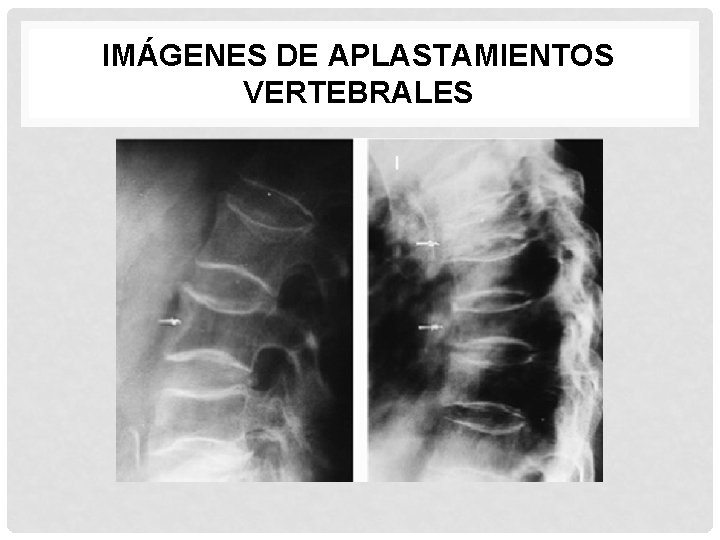 IMÁGENES DE APLASTAMIENTOS VERTEBRALES 