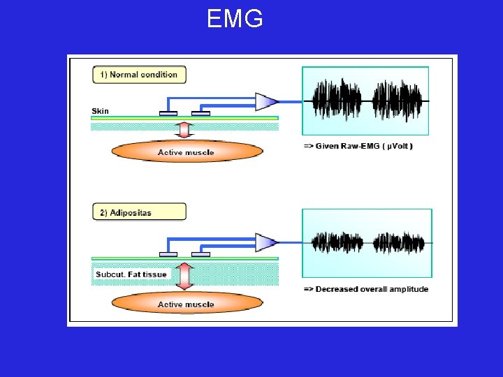 EMG 