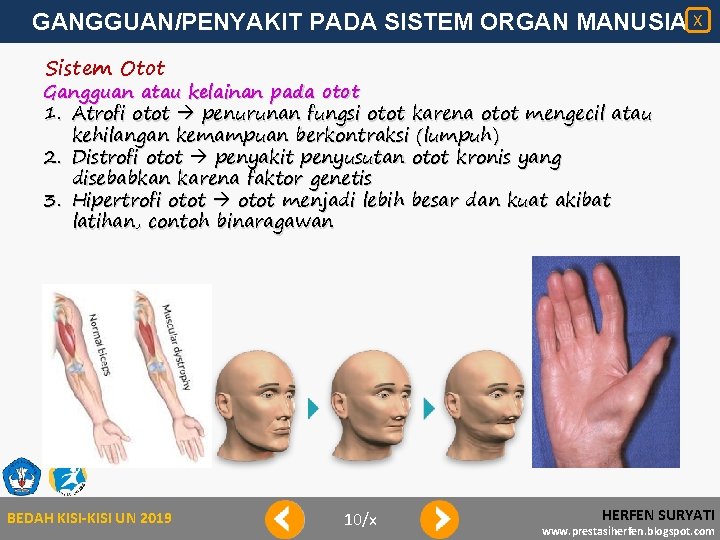 GANGGUAN/PENYAKIT PADA SISTEM ORGAN MANUSIA X Sistem Otot Gangguan atau kelainan pada otot 1.