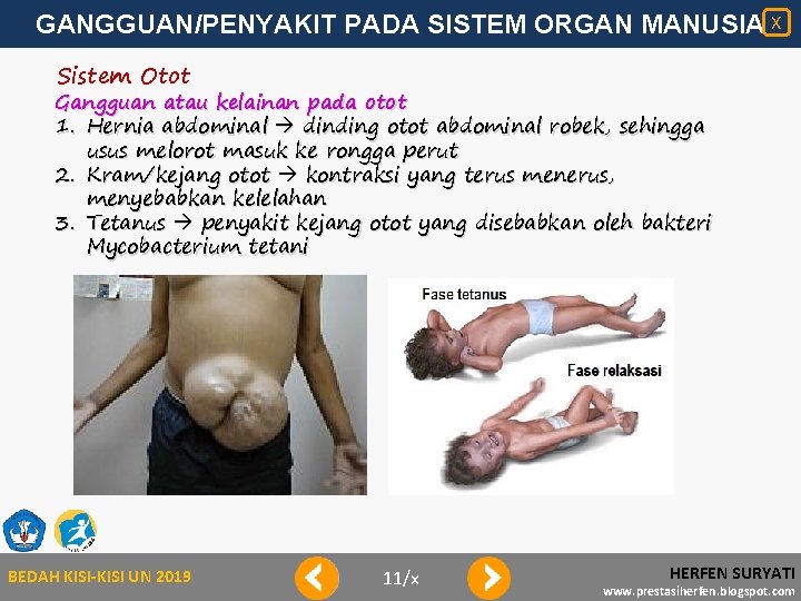 GANGGUAN/PENYAKIT PADA SISTEM ORGAN MANUSIA X Sistem Otot Gangguan atau kelainan pada otot 1.