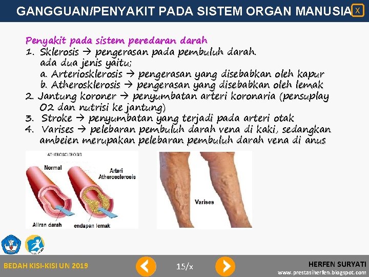 GANGGUAN/PENYAKIT PADA SISTEM ORGAN MANUSIA X Penyakit pada sistem peredaran darah 1. Sklerosis pengerasan