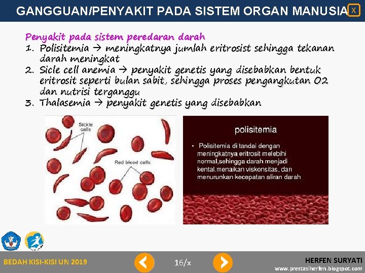 GANGGUAN/PENYAKIT PADA SISTEM ORGAN MANUSIA X Penyakit pada sistem peredaran darah 1. Polisitemia meningkatnya