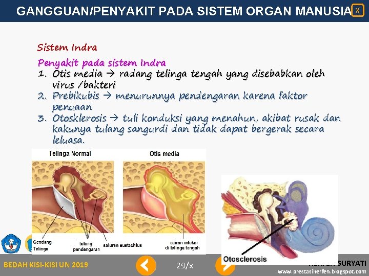 GANGGUAN/PENYAKIT PADA SISTEM ORGAN MANUSIA X Sistem Indra Penyakit pada sistem Indra 1. Otis