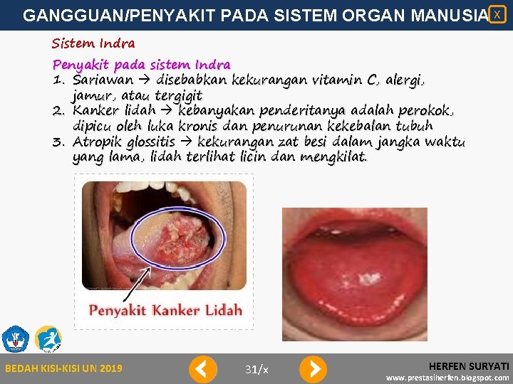 GANGGUAN/PENYAKIT PADA SISTEM ORGAN MANUSIA X Sistem Indra Penyakit pada sistem Indra 1. Sariawan