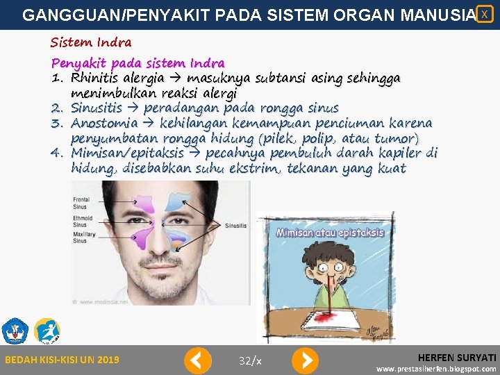 GANGGUAN/PENYAKIT PADA SISTEM ORGAN MANUSIA X Sistem Indra Penyakit pada sistem Indra 1. Rhinitis