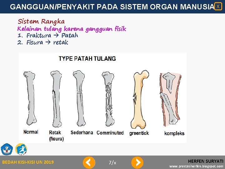 GANGGUAN/PENYAKIT PADA SISTEM ORGAN MANUSIA X Sistem Rangka Kelainan tulang karena gangguan fisik 1.