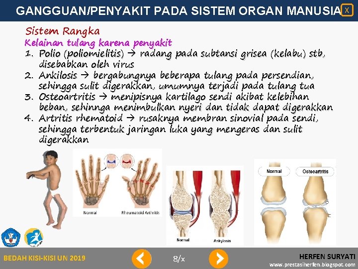 GANGGUAN/PENYAKIT PADA SISTEM ORGAN MANUSIA X Sistem Rangka Kelainan tulang karena penyakit 1. Polio