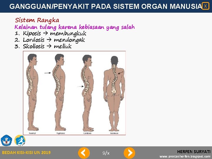 GANGGUAN/PENYAKIT PADA SISTEM ORGAN MANUSIA X Sistem Rangka Kelainan tulang karena kebiasaan yang salah