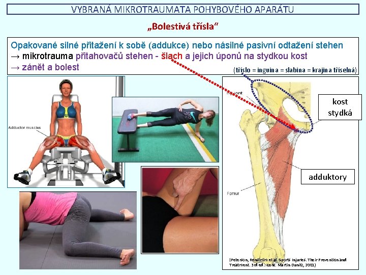 VYBRANÁ MIKROTRAUMATA POHYBOVÉHO APARÁTU „Bolestivá třísla“ Opakované silné přitažení k sobě (addukce) nebo násilné