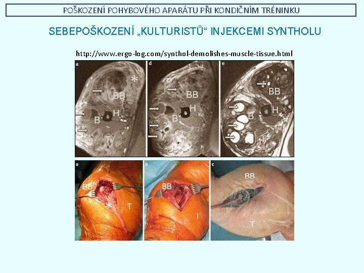 POŠKOZENÍ POHYBOVÉHO APARÁTU PŘI KONDIČNÍM TRÉNINKU SEBEPOŠKOZENÍ „KULTURISTŮ“ INJEKCEMI SYNTHOLU http: //www. ergo-log. com/synthol-demolishes-muscle-tissue.