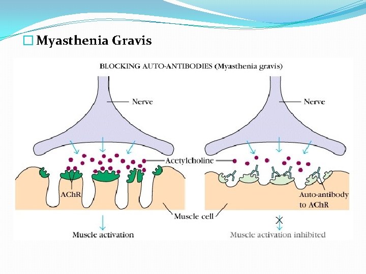 � Myasthenia Gravis 