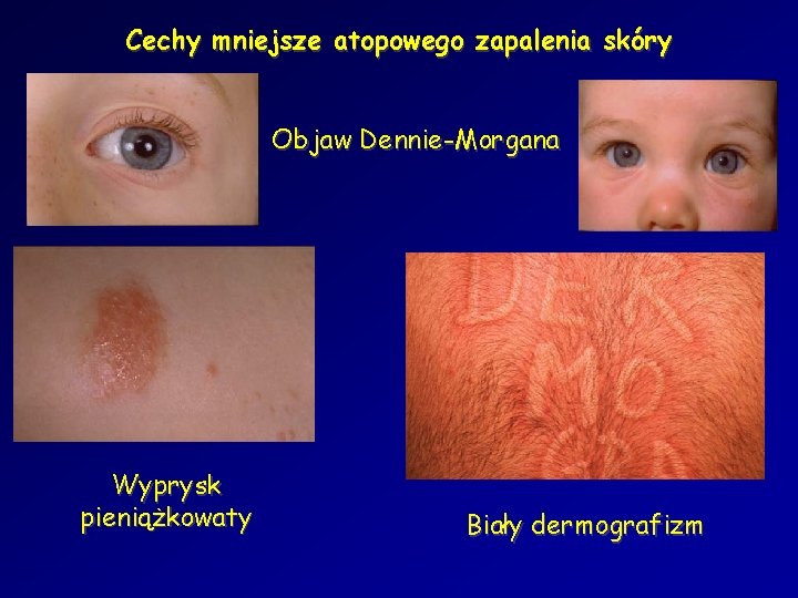 Cechy mniejsze atopowego zapalenia skóry Objaw Dennie-Morgana Wyprysk pieniążkowaty Biały dermografizm 