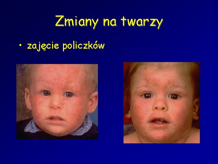 Zmiany na twarzy • zajęcie policzków 