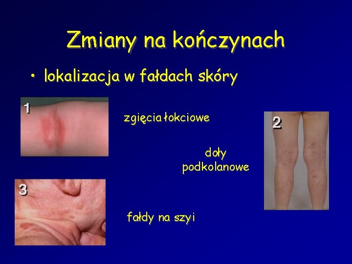 Zmiany na kończynach • lokalizacja w fałdach skóry zgięcia łokciowe doły podkolanowe fałdy na