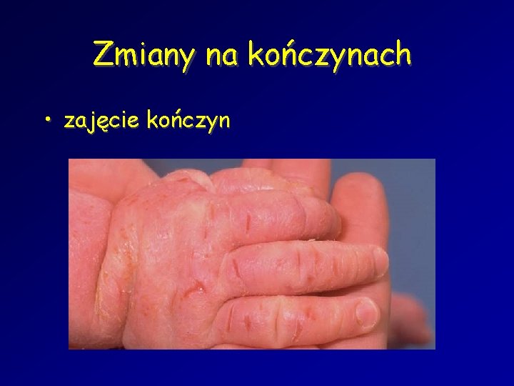 Zmiany na kończynach • zajęcie kończyn 