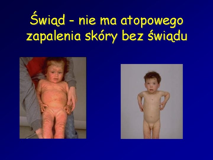 Świąd - nie ma atopowego zapalenia skóry bez świądu 