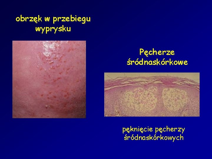 obrzęk w przebiegu wyprysku Pęcherze śródnaskórkowe pęknięcie pęcherzy śródnaskórkowych 