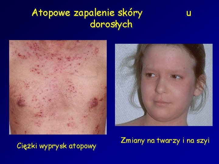 Atopowe zapalenie skóry dorosłych Ciężki wyprysk atopowy u Zmiany na twarzy i na szyi