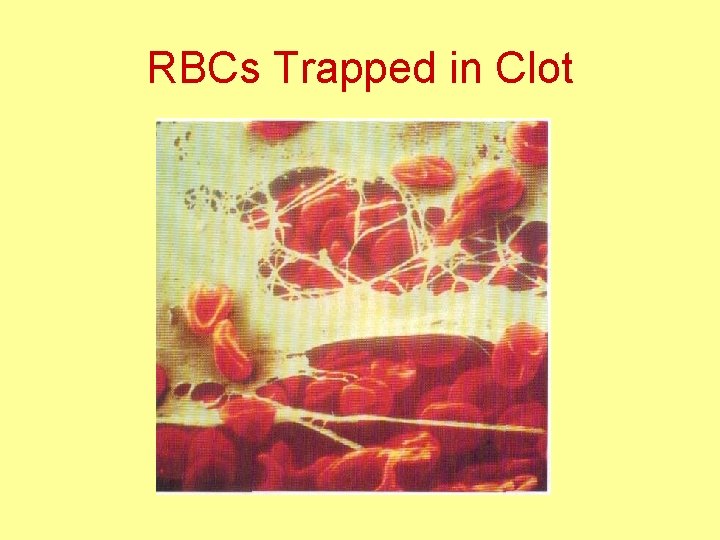 RBCs Trapped in Clot 