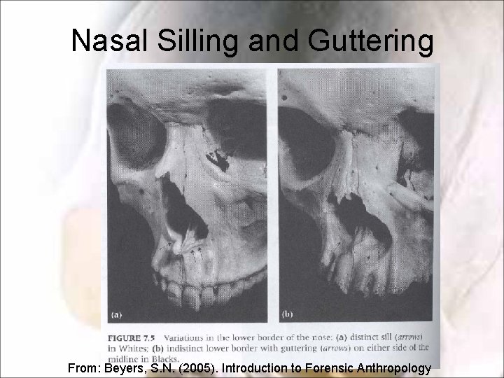 Nasal Silling and Guttering From: Beyers, S. N. (2005). Introduction to Forensic Anthropology Nasal Silling and Guttering From: Beyers, S. N. (2005). Introduction to Forensic Anthropology