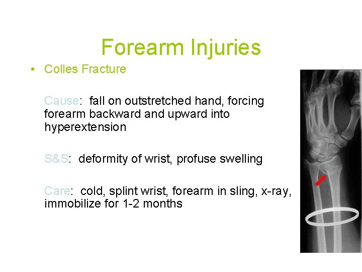 Forearm Injuries • Colles Fracture Cause: fall on outstretched hand, forcing forearm backward and