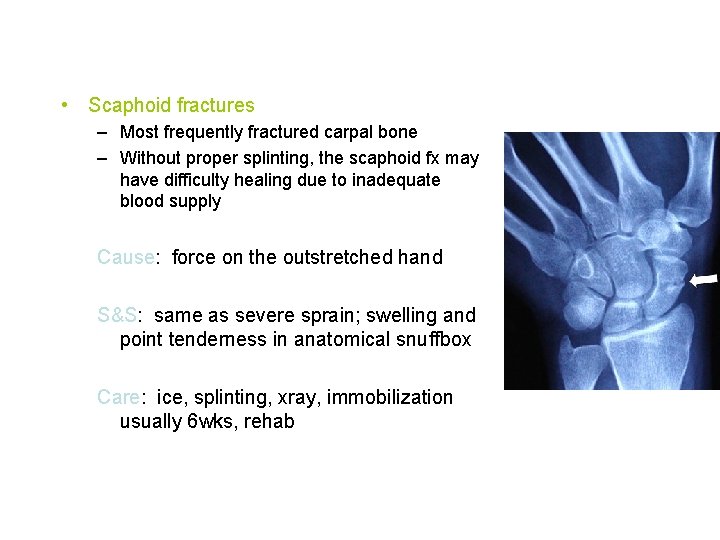  • Scaphoid fractures – Most frequently fractured carpal bone – Without proper splinting,