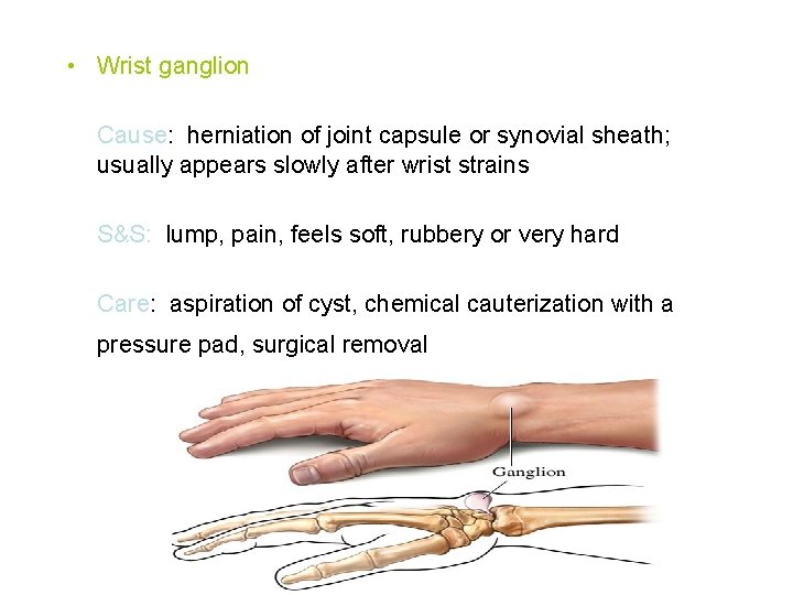  • Wrist ganglion Cause: herniation of joint capsule or synovial sheath; usually appears
