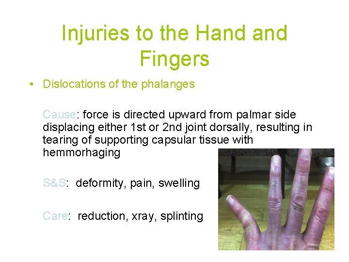 Injuries to the Hand Fingers • Dislocations of the phalanges Cause: force is directed