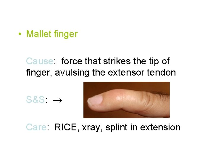  • Mallet finger Cause: force that strikes the tip of finger, avulsing the
