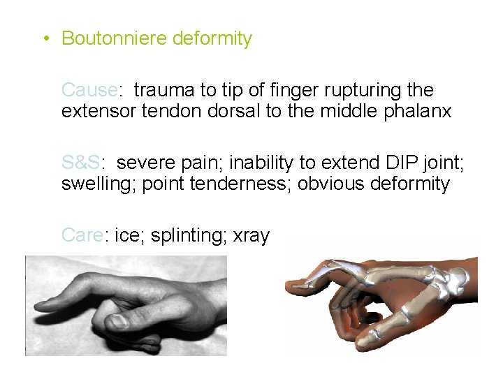  • Boutonniere deformity Cause: trauma to tip of finger rupturing the extensor tendon