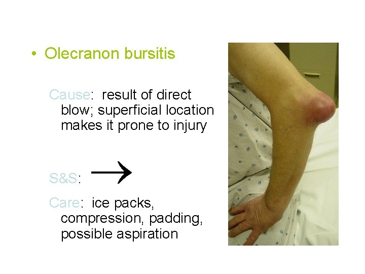  • Olecranon bursitis Cause: result of direct blow; superficial location makes it prone