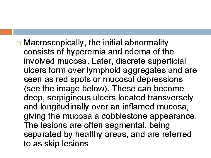  Macroscopically, the initial abnormality consists of hyperemia and edema of the involved mucosa.