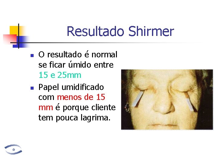 Resultado Shirmer n n O resultado é normal se ficar úmido entre 15 e