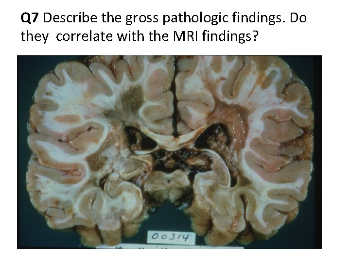 Q 7 Describe the gross pathologic findings. Do they correlate with the MRI findings?