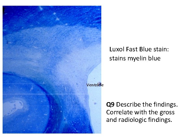 Luxol Fast Blue stain: stains myelin blue Ventricle Q 9 Describe the findings. Correlate