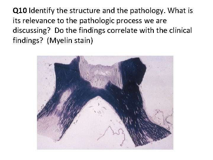 Q 10 Identify the structure and the pathology. What is its relevance to the