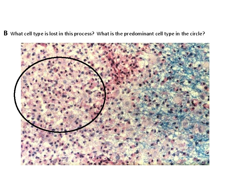 B What cell type is lost in this process? What is the predominant cell