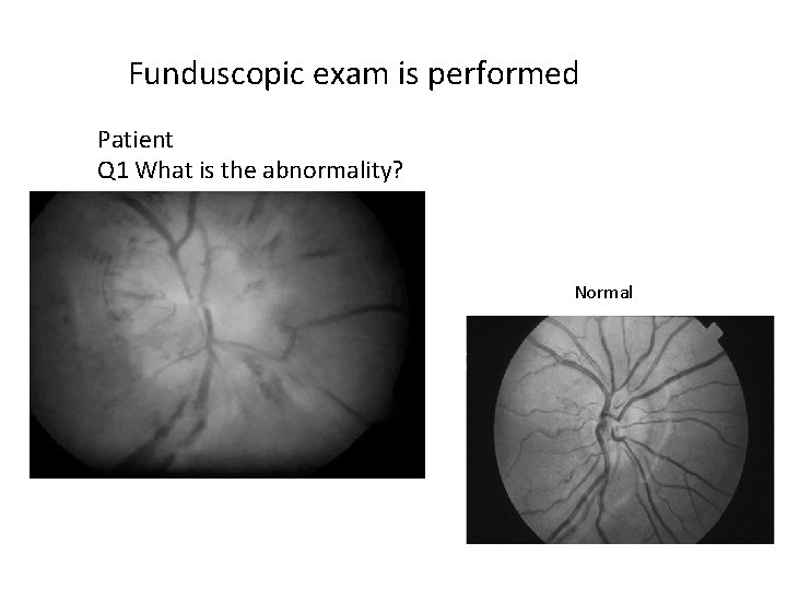 Funduscopic exam is performed Patient Q 1 What is the abnormality? Normal 