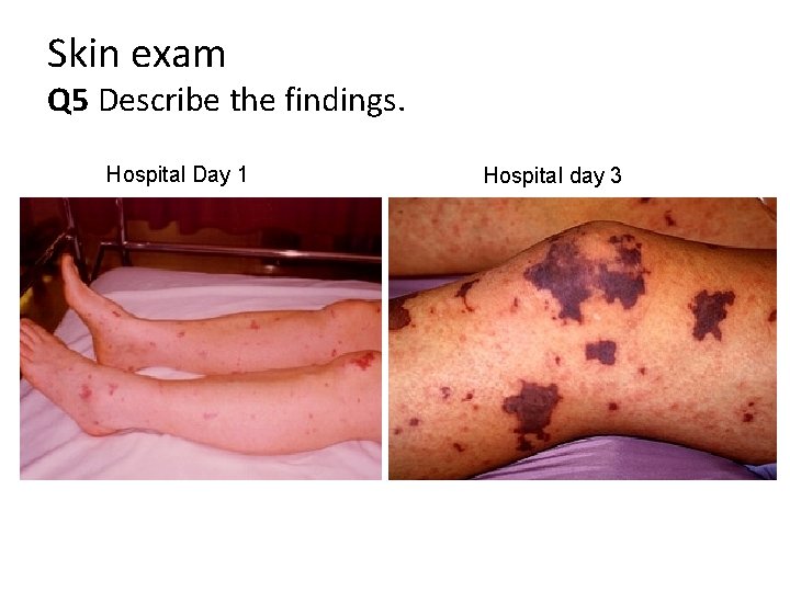 Skin exam Q 5 Describe the findings. Hospital Day 1 Hospital day 3 