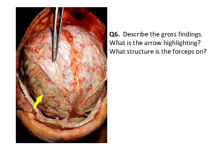 Q 6. Describe the gross findings. What is the arrow highlighting? What structure is